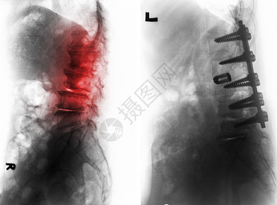 外科手术前后的脊柱性硬化症脊柱椎骨电影经营骨干腰椎放射科卫生疼痛保健图片