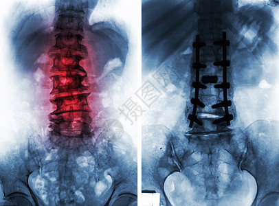 外科手术前后的脊柱性硬化症保健脊柱腰部腰椎治疗椎骨疼痛经营金属放射科图片