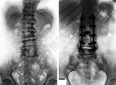 外科手术前后的脊柱性硬化症经营射线病人骨科放射科身体腰部卫生疾病x射线图片