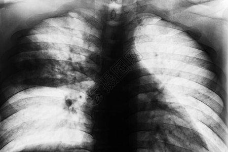 Lobar 肺炎细菌感染胸部x光呼吸病人x射线结核病疾病射线图片