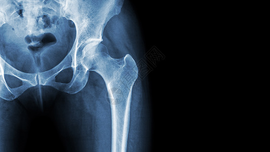 X光正常骨盆和臀关节 右侧空白区域保健x光疾病射线大腿疼痛科学腰部股骨屁股图片
