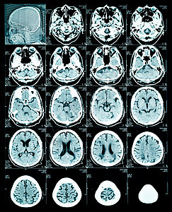脑部核磁共振扫描图像图片
