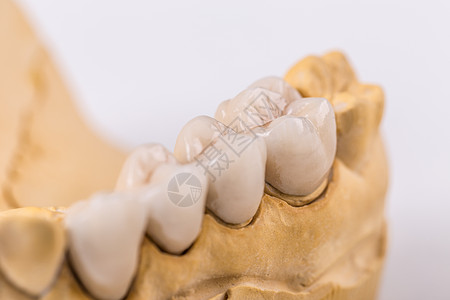 陶瓷制成的假体模仿白色医生牙齿牙科凹痕构造假牙假肢图片