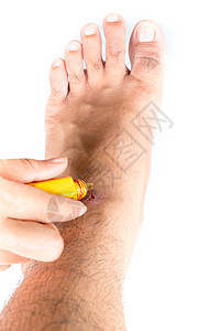 一个人在脚踝上护理伤痕身体伤害变色瘀斑膝盖正方形瘀点疼痛药品皮肤图片