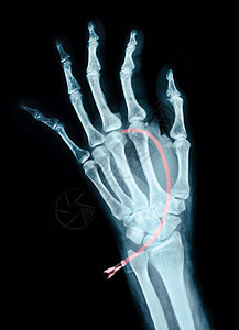 设备X光线上的人体左手诊断医院骨头医生科学治疗辐射屏幕放射科损害图片