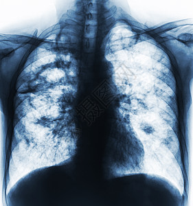 由于肺结核感染 右肺部和间歇性插入两个肺部的胸腔洞穴 胸部露出胶片X射线解剖学身体扫描射线结核医院科学放射科病人空腔图片