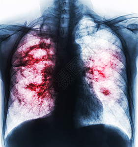 由于肺结核感染 右肺部和间歇性插入两个肺部的胸腔洞穴 胸部露出胶片X射线疾病药品射线结核病肺炎扫描x光男人解剖学诊断图片