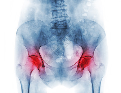骨质疏松病病人和关节炎的乳胶X射线骨盆风湿大腿保健扫描男人股骨风湿病整骨痛苦射线图片