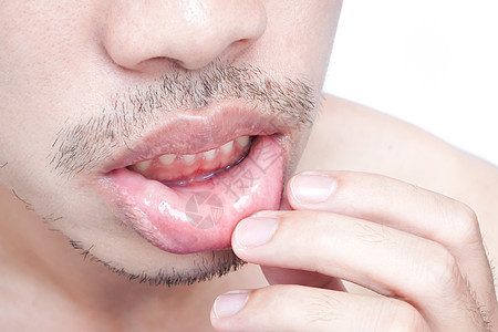 关紧嘴唇 男人有健康问题的保健疾病感染皮肤药品医疗胡须疼痛口服痛苦发烧图片