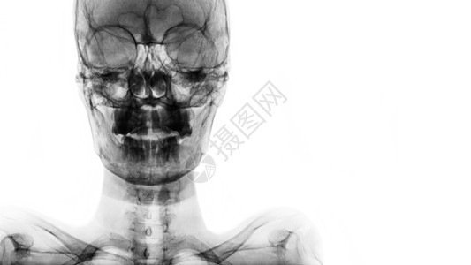 X射线胶片Skull AP 在右侧显示正常人的头骨和空白区域射线医院卫生脖子骨骼放射科扫描男人身体电影图片