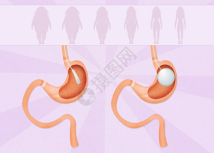 内气气球卫生插图饮食外科肥胖可调器官减肥保健手术图片