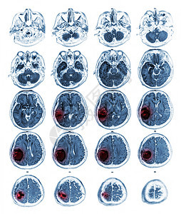 MRI脑部显示右皮骨叶上的脑瘤中风手术核磁共振电脑诊断神经元病人疾病扫描电影图片