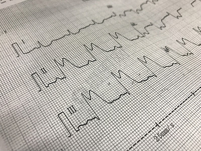 ECG纸上的ST海拔脉冲保健支架疾病攻击风险血管文档教育科学图片