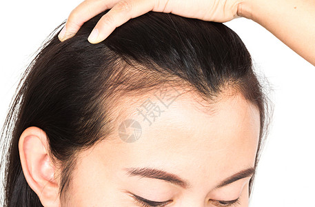妇女因保健洗发水和beau而严重理发问题秃头发型头皮医疗保险梳子治疗白色移植医疗假发图片