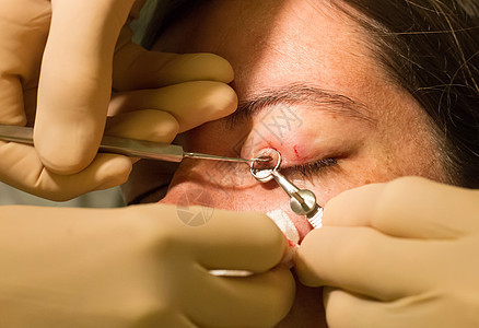 保健概念     眼科检查和手术期间的查拉松病菌皮肤眼睛眼皮痛苦医生链球菌细菌眼泪睑板图片