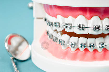 带有金属铁丝牙牙套的牙齿模型保险畸形外科示范健康学习诊所假牙手术夹子图片