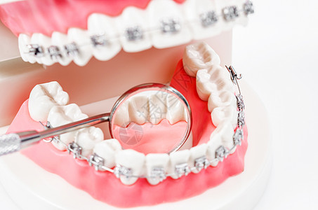 带金属丝牙套和镜子牙科设备的牙齿模型示范牙医治疗诊所外科定制健康案例手术畸形图片