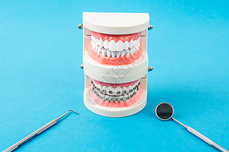 将牙齿模型和牙模型与金属铁线牙牙套作比较假牙报销诊所扣子示范夹子学习畸形外科保险图片