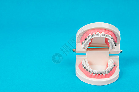 带有金属铁丝牙套的牙齿模型夹子手术塑料蓝色健康扣子矫正定制案例示范背景图片