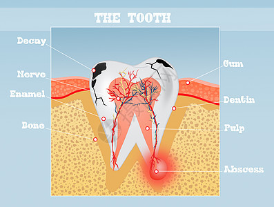牙齿计划鞑靼疼痛治愈药物矫正口服牙科插图搪瓷空腔图片