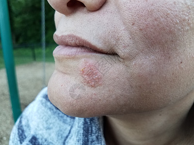 女人的下巴和脸上有红疹子和泡泡女性皮肤水泡卫生水疱女士保健医疗皮疹图片