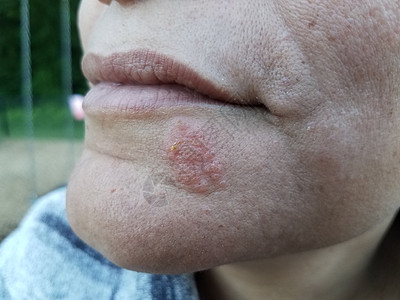 女人的下巴和脸上有红疹子和泡泡卫生皮疹医疗女性皮肤水泡保健水疱女士图片