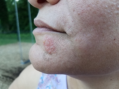 女人的下巴和脸上有红疹子和泡泡女性水疱女士水泡保健医疗皮疹卫生皮肤图片