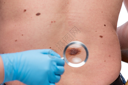 对病人背部皮肤进行皮肤检查的皮肤科专家图片
