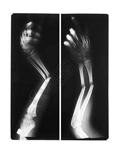 显示双骨折臂骨图片