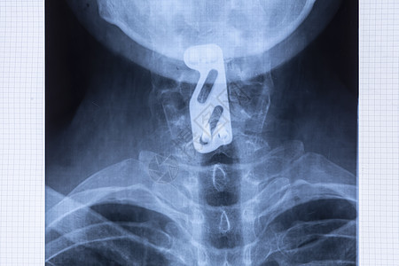 用于支撑子宫颈脊椎的钛板的放射摄影图片