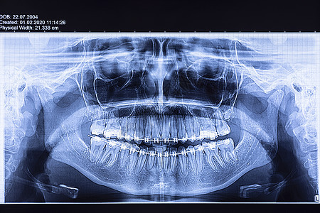带牙套的牙科放射线口腔科考试射线支撑放射科x射线手术医院扫描解剖学图片