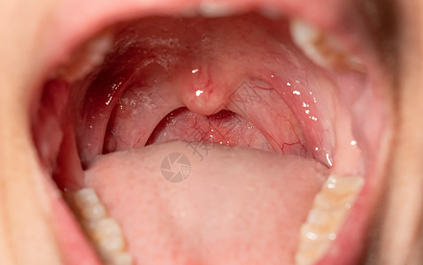 喉咙痛 喉咙肿胀 用后继剂闭合嘴张开治疗卵泡血管淋巴卫生细胞疼痛感染口咽咽喉图片