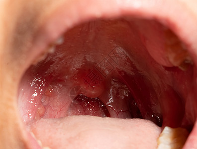 喉咙痛 喉咙肿胀 用后继剂闭合嘴张开疼痛病人疾病流感咽喉软腭卵泡解剖学血管卫生图片