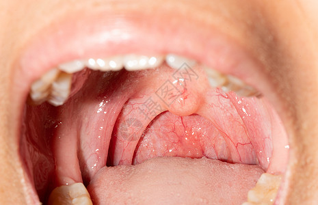 喉咙痛 喉咙肿胀 用后继剂闭合嘴张开咽喉流感舌头感染牙科疾病治疗血管疼痛卫生图片