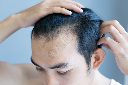 男青年在医疗保健 医疗和医疗方面严重发毛问题美丽洗发水损失造型师蓝色灰色生长假发男性男人图片