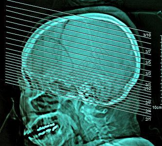 人体大脑计算机化胶片X射线摄影谐振卫生技术血管治疗病人x光扫描诊断医院图片