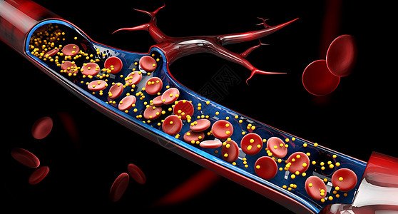 3d 血液血管中的钙含量说明插图动脉疾病血液学血栓溪流血流管子测试显微镜图片