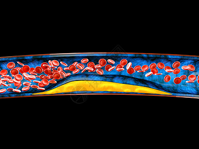 3d 用凝固胆固醇的立体积块显示血细胞保健动脉封锁硬化动脉粥样硬化积累静脉风险科学外科背景图片