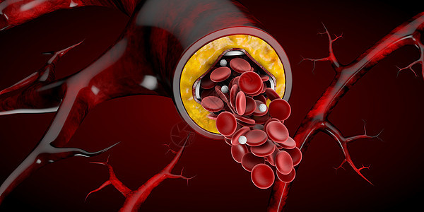 支架医疗植入物概念作为心脏病治疗符号 3D 图案解剖学细胞中风牌匾程序导管气球攻击静脉血管图片