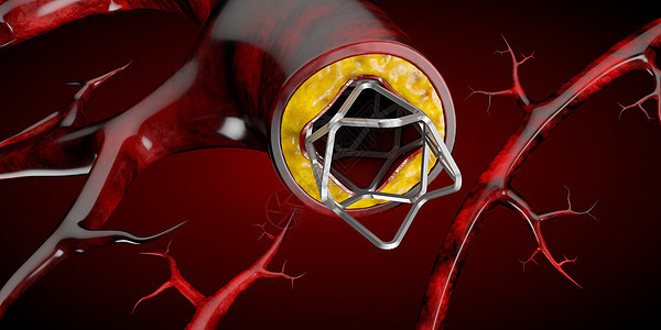 支架医疗植入物概念作为心脏病治疗符号 3D 图案手术动脉粥样硬化细胞攻击血管金属流动导管牌匾外科图片