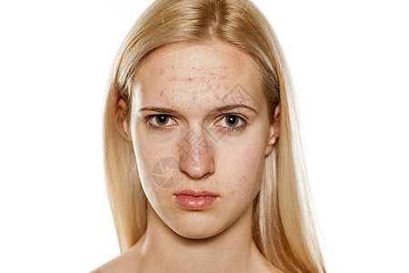 皮肤有问题的女孩缺陷女士药品疙瘩感染皮肤科美容脓包女性学生图片