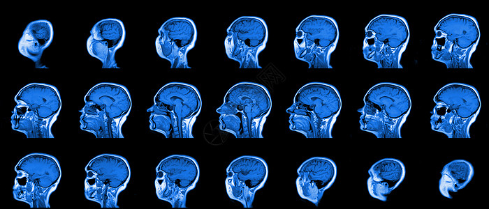 一套系列MRI扫描仪 对60岁的幼女在人表或纵向平面上的头部进行连续式磁RI扫描技术实验室祖母颅骨学习飞机断层病人保健药品图片