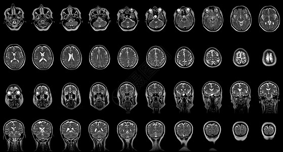 一套系列MRI扫描仪 对60岁的古巴女性头部进行前方和水平平面的连续核磁共振扫描图片