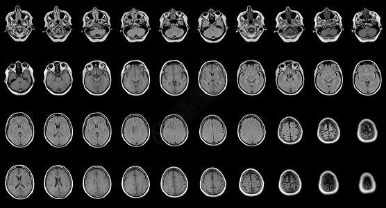 对60岁的天主教女性头部进行一系列连续核磁共振扫描图片