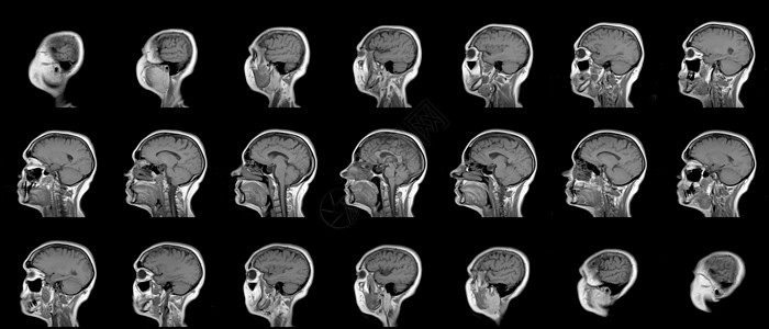 一套系列MRI扫描仪 对60岁的幼女在人表或纵向平面上的头部进行连续式磁RI扫描辐射病人谐振放射科断层祖母x光解剖学女性射线图片