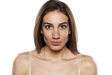 皮肤有问题 美丽的年轻女性美女感染女孩青春期斑点肤色身体刺激编辑皮肤科药品图片