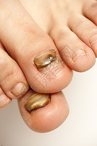 脚指甲的真菌感染图片