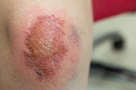 新的伤口 淋巴和鲜血印在亚裔女性膝盖底部援助事故卫生划痕身体保健感染伤害创伤皮肤图片