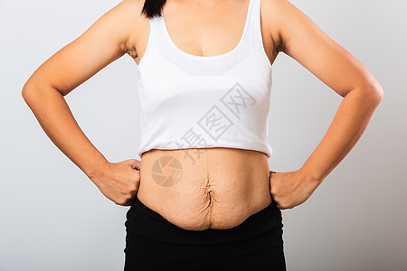女人露出伸展的印记 松松下腹部皮肤肚子怀孕妈妈女孩皮肤科重量女士药品母亲身体图片