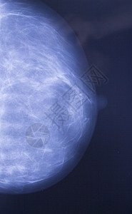 用肿瘤对乳房进行X光检查肿瘤学摄影癌症射线生长放射科保健女性考试卫生图片